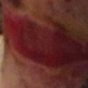 Tilhelet sår på hestebeinet